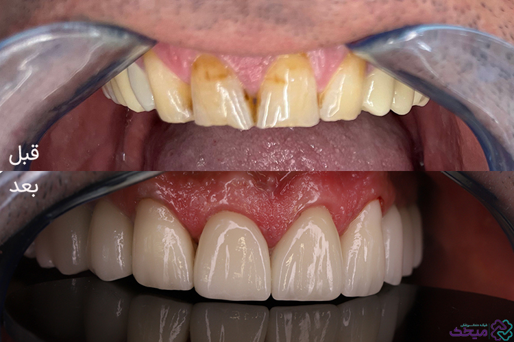 همه چیز در مورد قیمت لمینت دندان 1 images 1715499852 6640734c94018